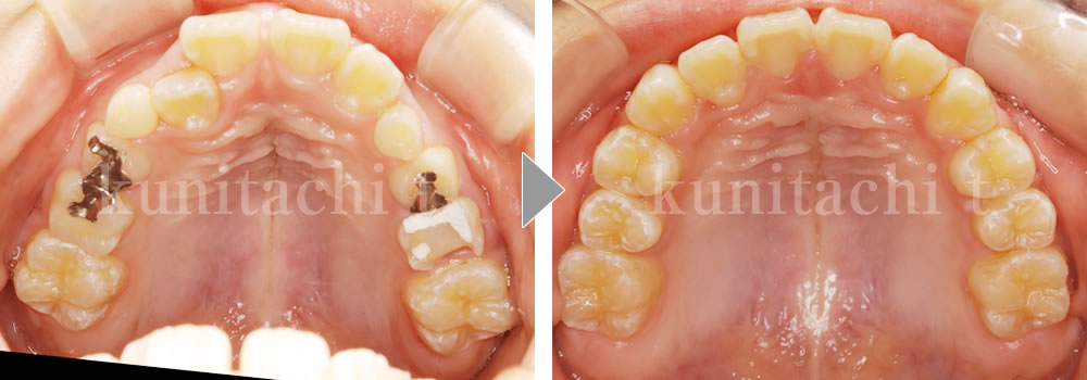 小児矯正治療前後の比較