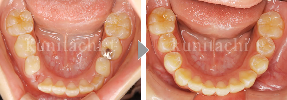 小児矯正治療前後の比較