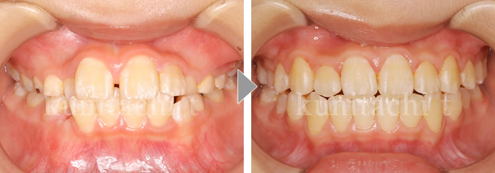 小児矯正治療前後の比較