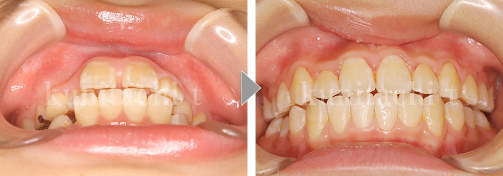小児矯正治療前後の比較