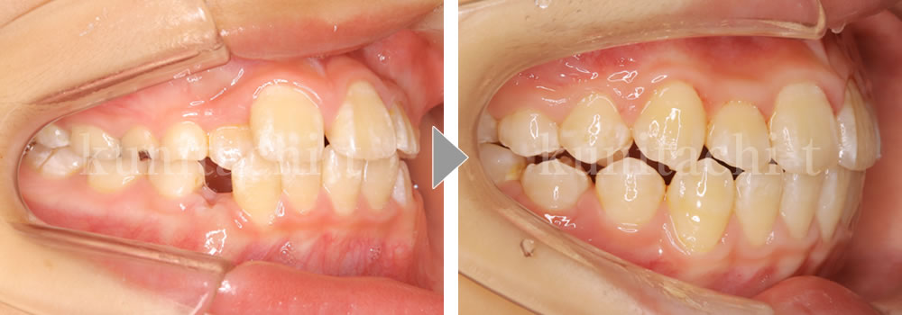 小児矯正治療前後の比較