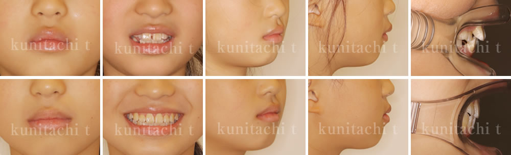 小児矯正治療前後の比較