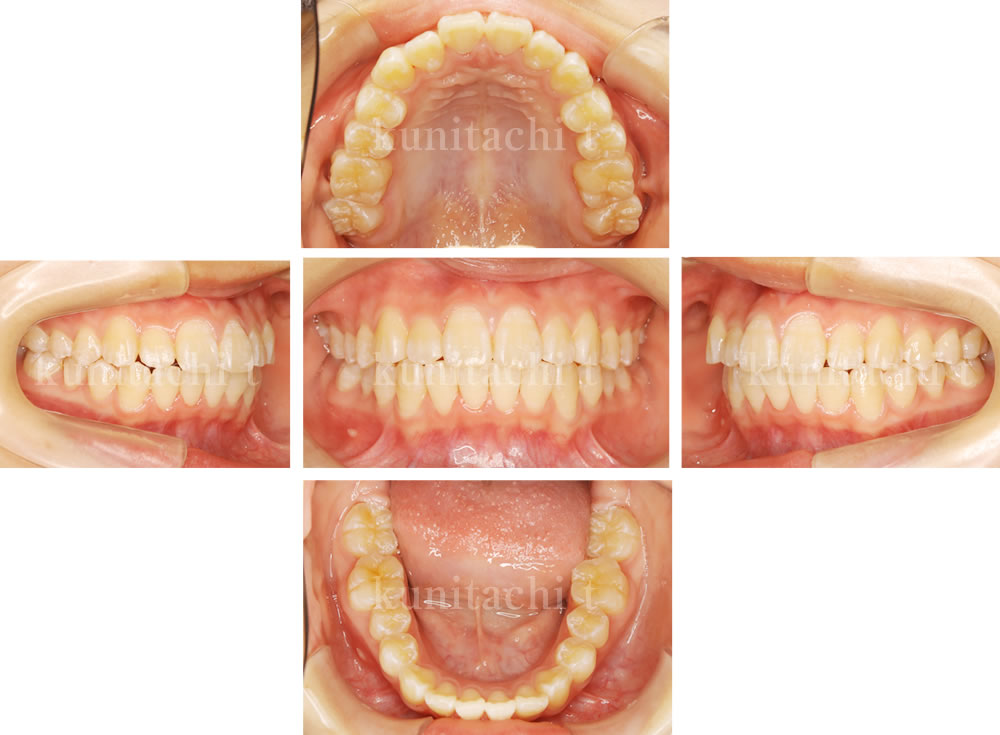 矯正終了より3年後