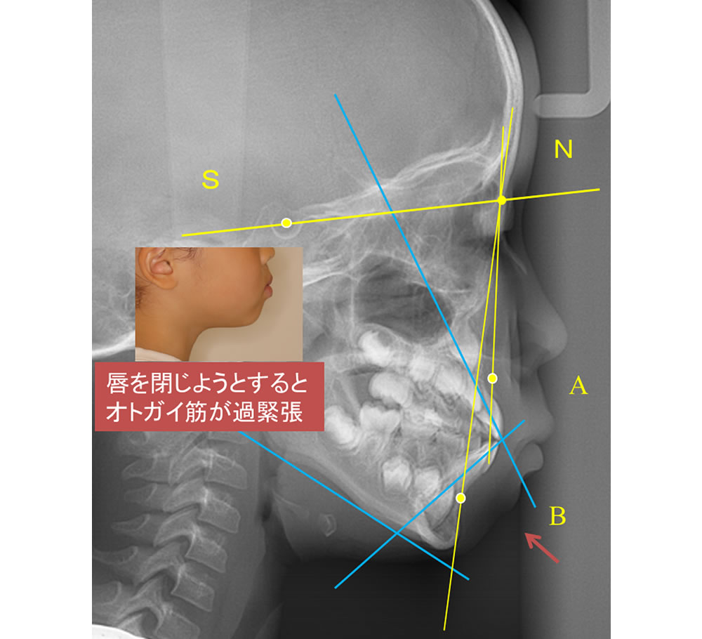 側貌骨格レントゲン写真