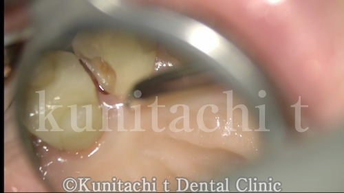 エキスカによる虫歯除去