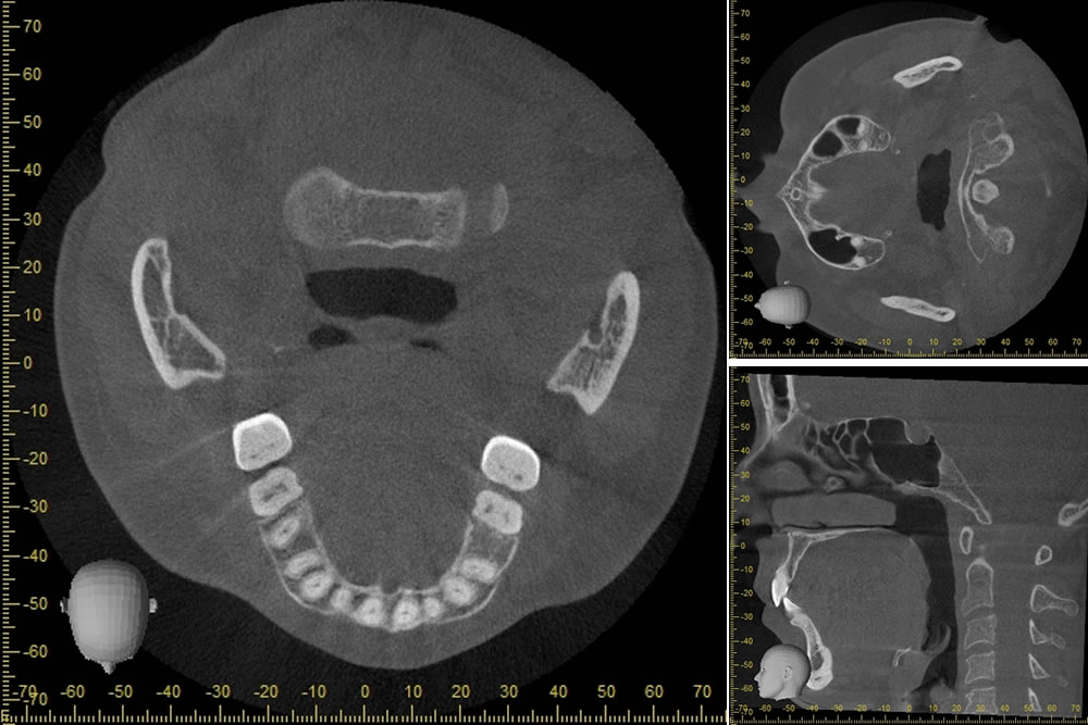 歯科用CT