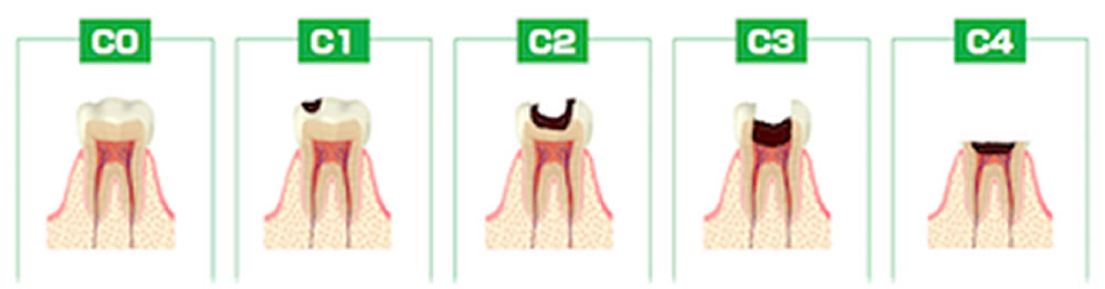 虫歯の進行順