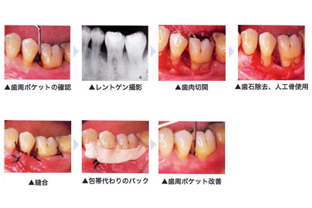歯周再生療法