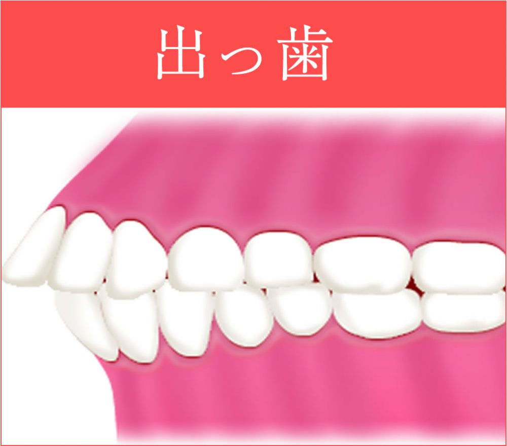 出っ歯
