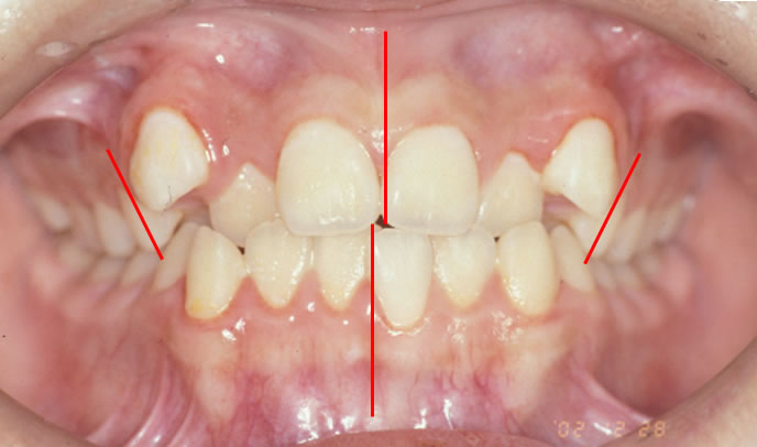 歯軸傾斜改善歯科矯正前