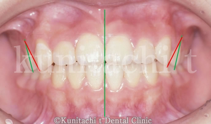 歯軸傾斜改善歯科矯正後