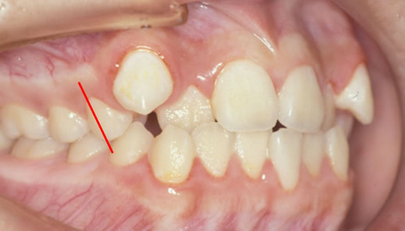 歯軸傾斜改善歯科矯正前