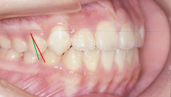 歯軸傾斜改善歯科矯正後