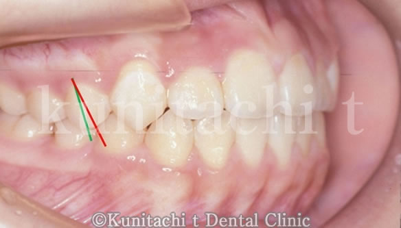 歯軸傾斜改善歯科矯正後