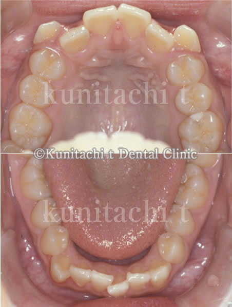 歯軸傾斜改善歯科矯正前