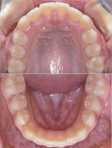 歯軸傾斜改善歯科矯正後